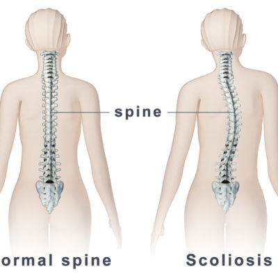 5 Early Signs of Scoliosis that You Should be Aware of