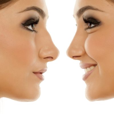 7 THINGS TO AVOID AFTER RHINOPLASTY