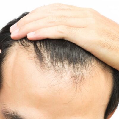 Hair loss expert Dr. Knut Moe on combatting a receding hairline